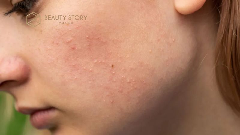 Nổi mụn nước trên mặt là dấu hiệu của bệnh gì?