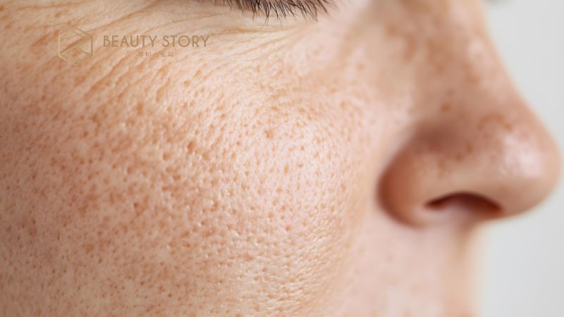 Cách trị nám gò má tại nhà cực đơn giản bằng mẹo tự nhiên