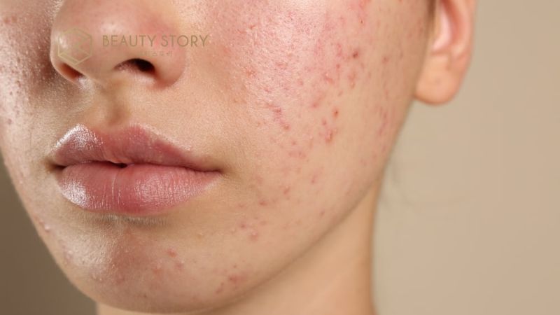 Chấm mụn viêm sưng cấp tốc giúp xẹp mụn chỉ sau một đêm