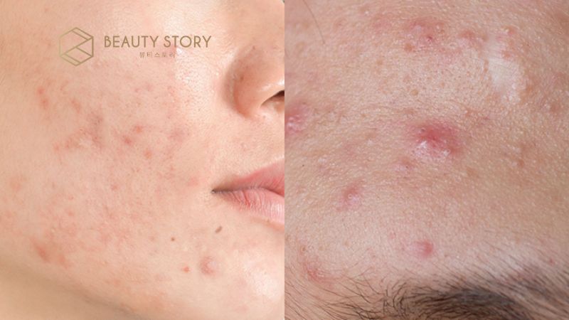 Phác đồ điều trị mụn nang sưng đỏ không nhân tại nhà