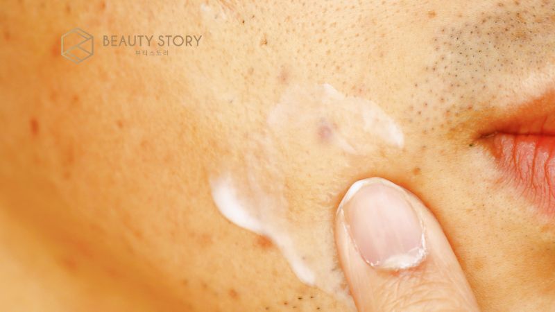 Cách làm hết mụn thâm tự nhiên tại nhà cho làn da láng mịn